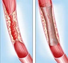 Pakistan Manufacturing Cheaper Local Stents